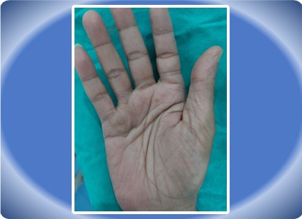 DEPUITREN CONTRACTURE